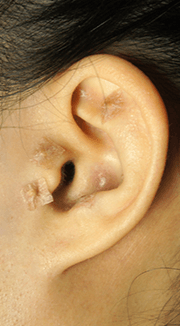 lalafuj auriculoterapia