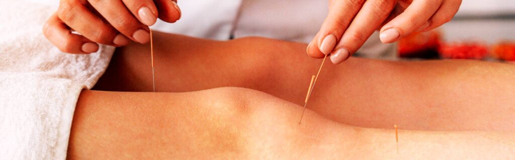 acupuntura qualidade de vida, diminui ansiedade, relaxamento profundo